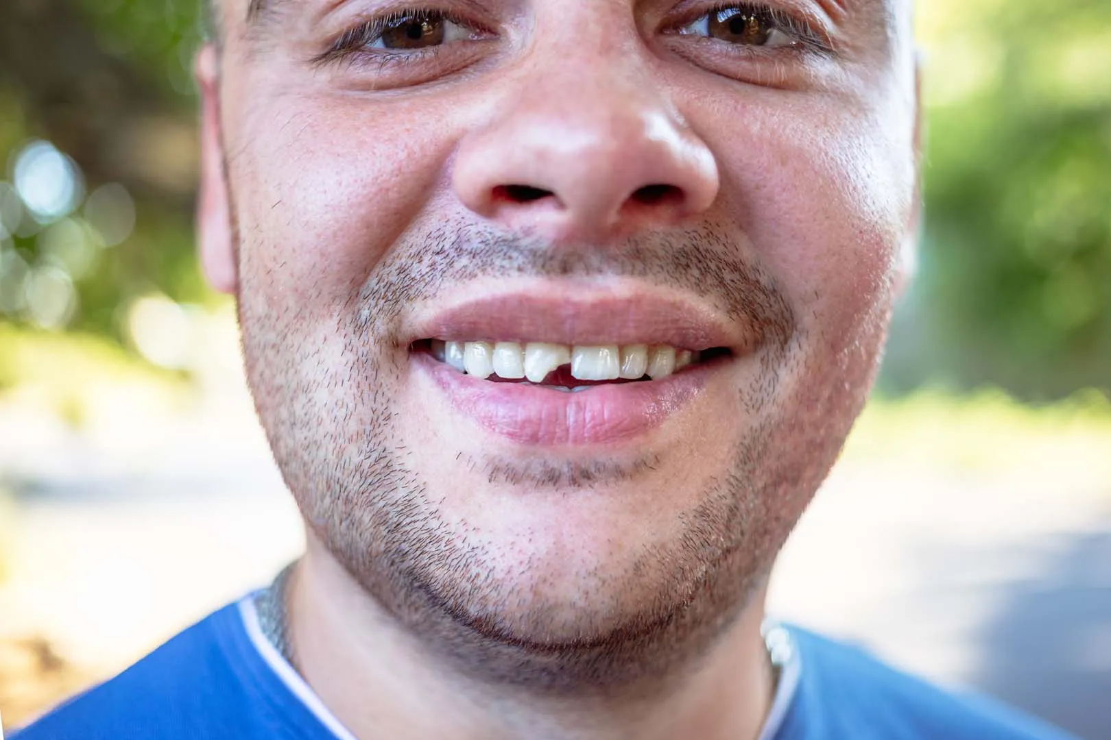 Chipped and cracked tooth repair at Gentle Dental